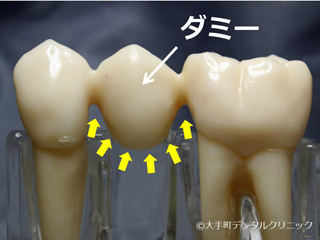 歯の治療ブリッジの解説