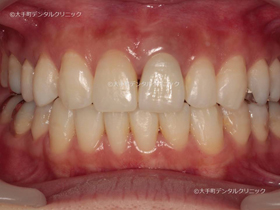 東京で審美歯科治療おすすめの歯科の前歯例治療後