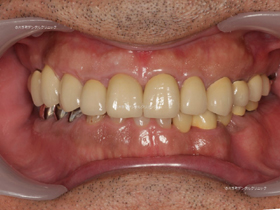 丸の内の歯科№1のインプラント治療例（治療後）