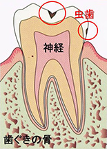 歯が痛い原因３