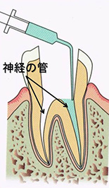 東京で歯の根の治療のおすすめの歯医者