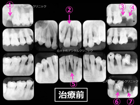 重度歯周病ケース２治療前のレントゲン