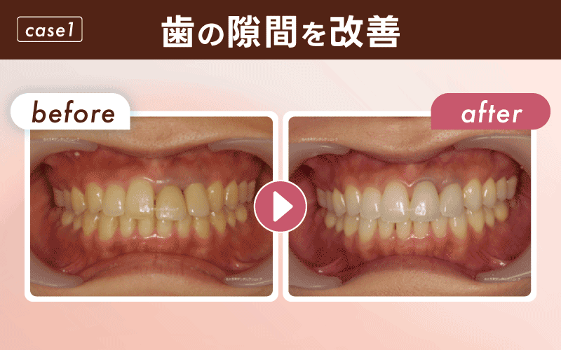 マウスピース矯正 症例