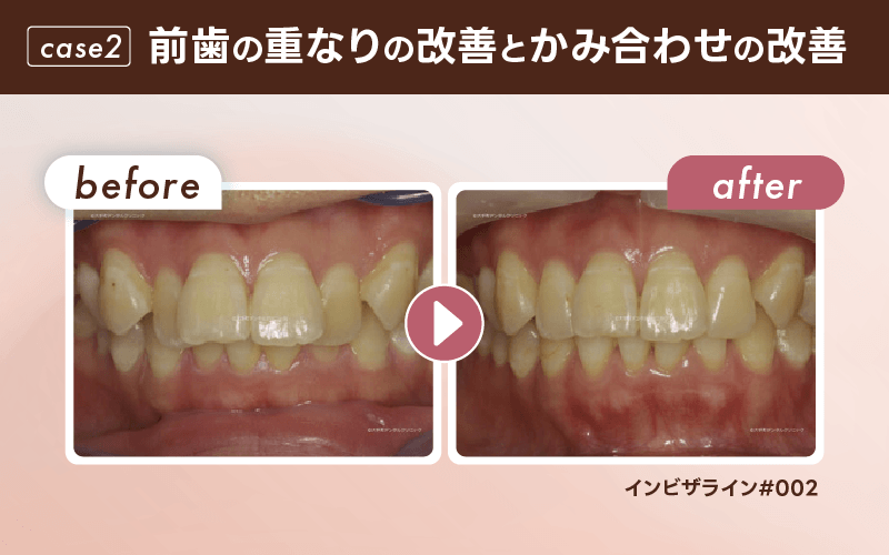 マウスピース矯正 症例