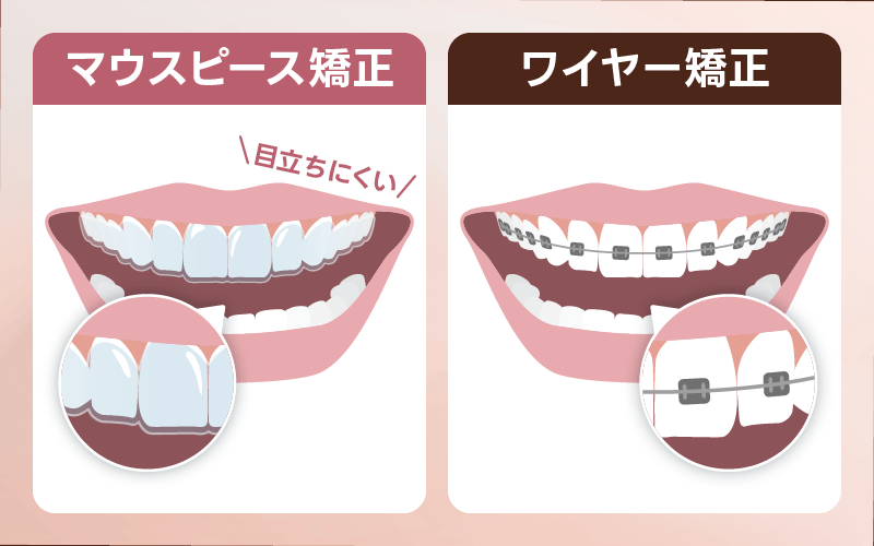 マウスピース矯正 ワイヤー矯正