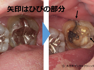 歯が割れている例