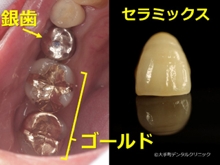 大手町の歯科で行なった歯の被せもの