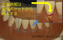 インフェクションコントロール（歯周病治療）の説明の図
