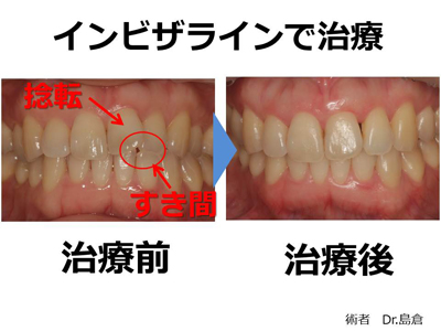 治療前の歯並びの状態の解説
