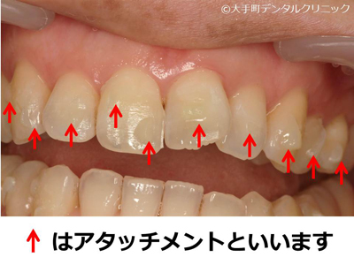 インビザラインのアタッチメント例