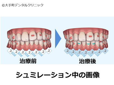 インビザラインのシュミレーション時の画像