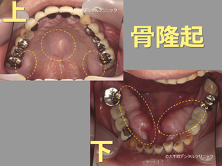 骨隆起の画像