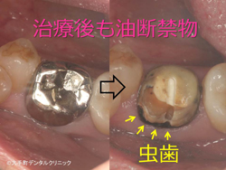 治したところもまた虫歯になります（２次カリエス）