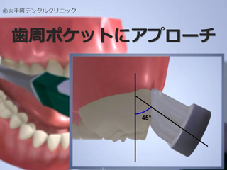 歯周ポケットを磨く方法