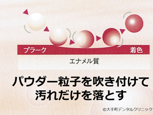 炭酸ナトリウムを使用した歯のクリーニング