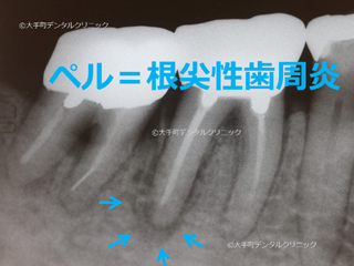 ペル、根尖性歯周炎の例