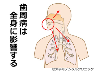 歯周病と全身疾患との関係の図表