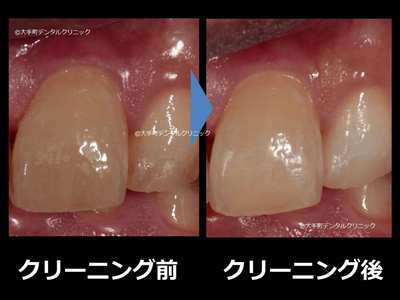 歯を白くするクリーニングの治療前と治療後の比較