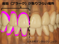 歯のお手入れ、プラークコントロールのコツ（その１）