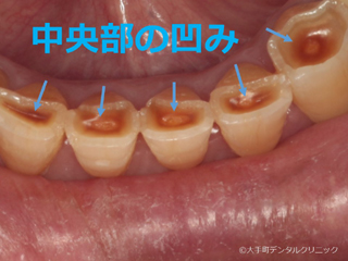 歯の酸蝕症の画像