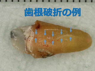 歯根破折（しこんはせつ）の例
