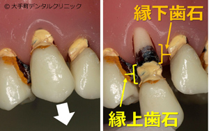 縁上歯石と縁下歯石の違い（歯周病）