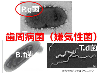 歯周病菌の画像