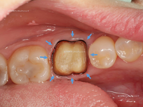 丸の内の歯科のセラミックスクラウンの型取り時