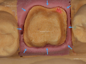 丸の内の歯医者のセラミックスクラウンの模型例