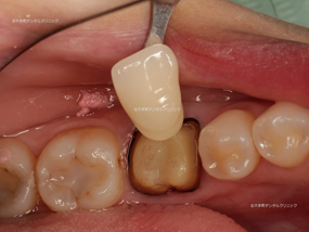 東京丸の内の歯科でセラミックスクラウン制作時の色合わせ時