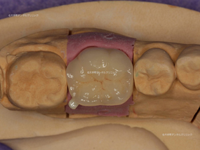 オールセラミックスクラウン完成時