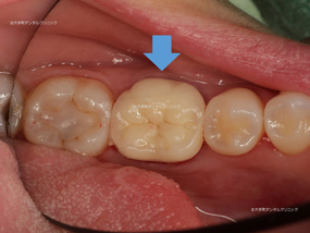 東京都丸の内の歯医者（歯科）のセラミックスクラウンの治療例の術後