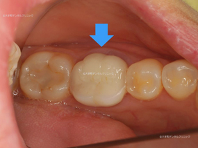 東京都丸の内の歯医者（歯科）のセラミックスクラウンの治療例の術前