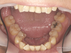 大手町でマウスピース矯正おすすめの歯科の治療前の画像