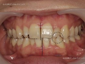 東京でマウスピース矯正おすすめの歯科での治療前の状態