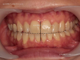 東京でマウスピース矯正おすすめの歯科での治療後の状態