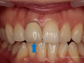 上前歯のセラミックスクラウンの治療例の術前
