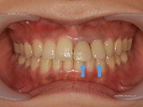 審美歯科 東京 | 前歯の治療例の術前