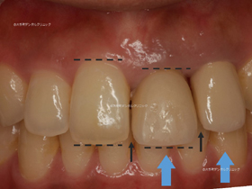 審美歯科 東京 | 前歯の治療例の術前の解説