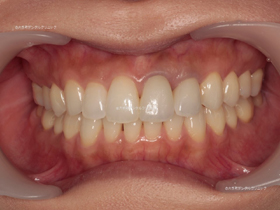 審美歯科 | 矯正治療とホワイトニングを併用した治療例の治療後