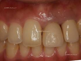 上の前歯の審美歯科の治療例の治療前