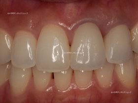 上の前歯の審美歯科の治療例の治療後