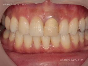 東京で審美歯科治療おすすめの歯科の前歯例治療前