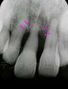 歯周病治療で歯ぐきの骨ができた例の術後、東京で歯周病治療おすすめの歯医者