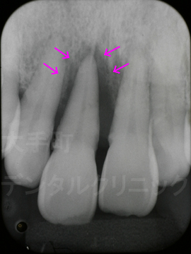 歯周病治療で歯ぐきの骨ができた例の術前、東京で歯周病治療おすすめの歯医者