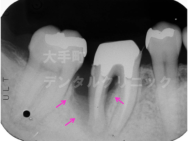 歯周病の治し方、再生治療（術前）