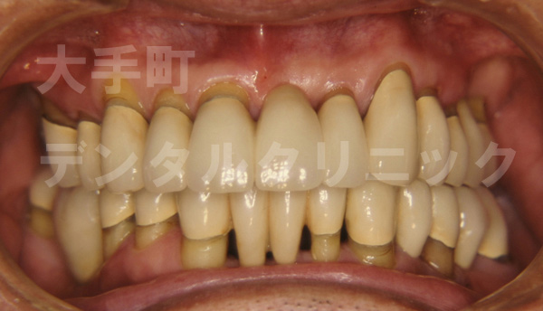 歯周病の治し方、難しい例（治療後）