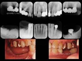 東京のインプラント専門医がおこなった治療の治療前の状態