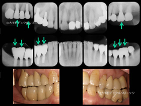 東京のインプラント専門医がおこなった治療の治療後の状態