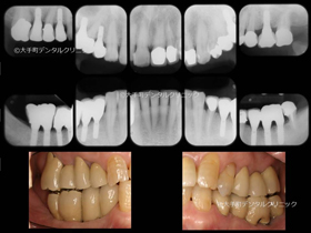 東京でインプラントの名医の治療例